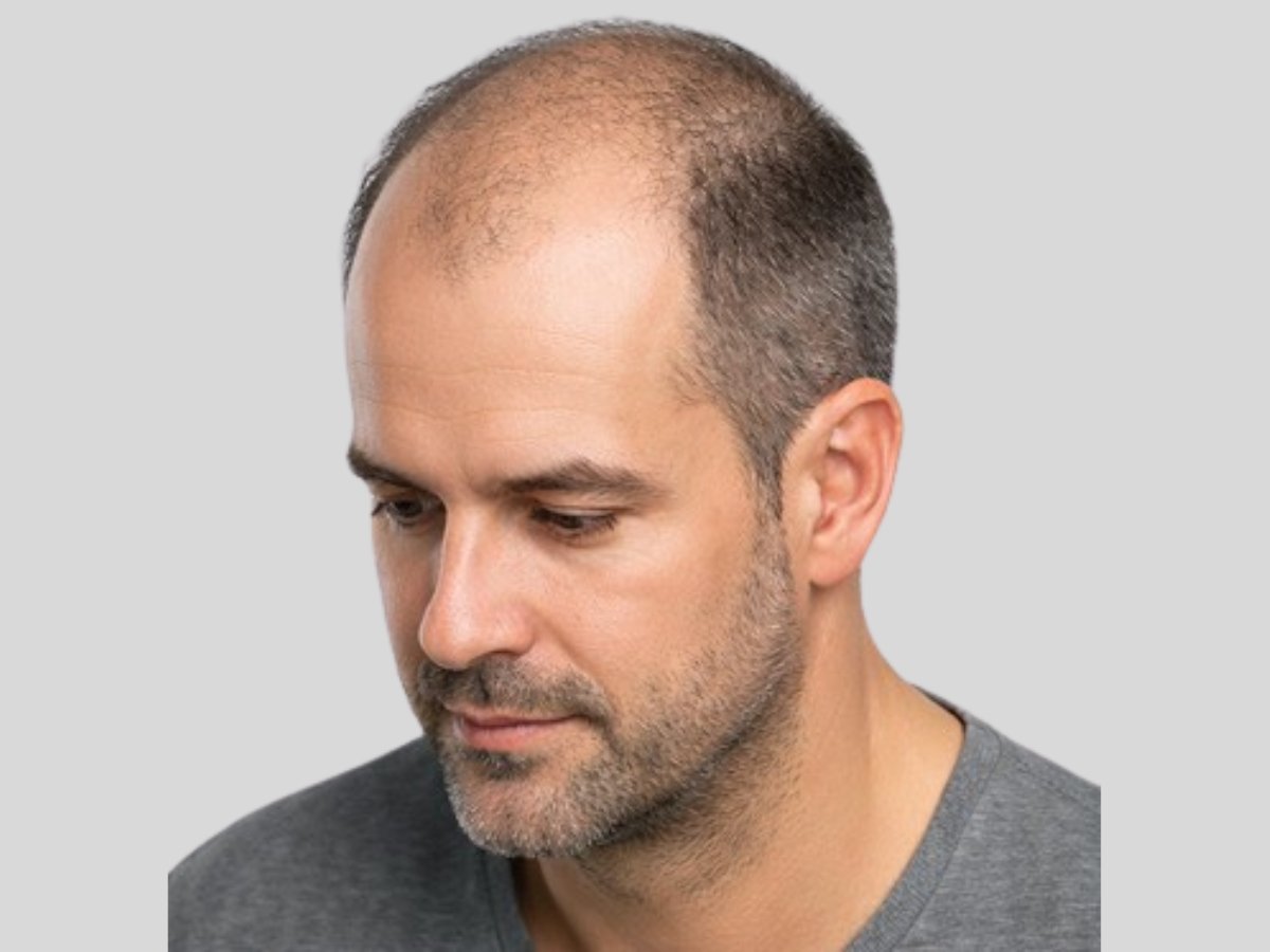 Transplante capilar masculino técnica FUE